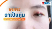 เช็กตุ่มที่เปลือกตาแบบไหนอันตราย ควรรีบพบจักษุแพทย์