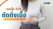 เทคนิค ESD ตัดติ่งเนื้อทางเดินอาหาร ไม่ต้องผ่าตัด ลดเสี่ยงมะเร็ง