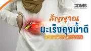 สัญญาณเตือนมะเร็งถุงน้ำดี รู้ทันก่อนลุกลาม แพทย์แนะสังเกตอาการปวดชายโครงขวา