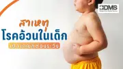 โรคอ้วนในเด็ก ภัยเงียบเสี่ยงโรคเรื้อรังตั้งแต่อายุน้อย แนะเกณฑ์สังเกต