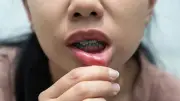 ร้อนในห้ามกินอะไร เปิดลิสต์อาหารต้องห้าม 5 กลุ่ม ยิ่งกินแผลยิ่งลามหายช้า
